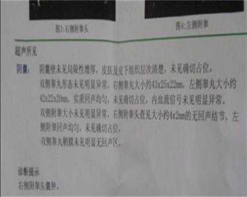 无精症不育